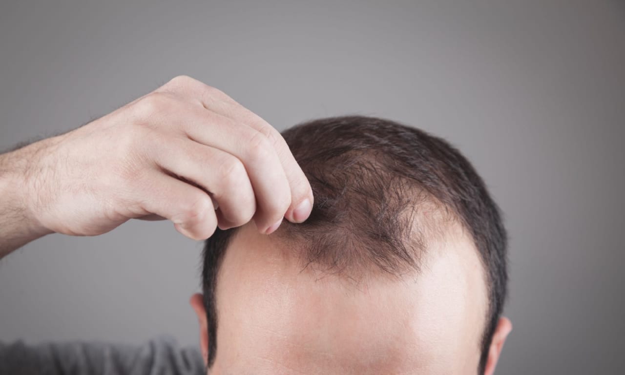 prevent hair loss