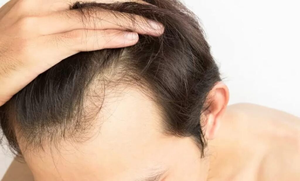 prevent hair loss